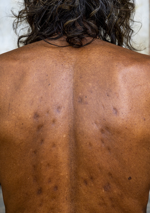 Scars in the back of a devotee who use to hang himself with hooks, Dhaka Division, Dhaka, Bangladesh