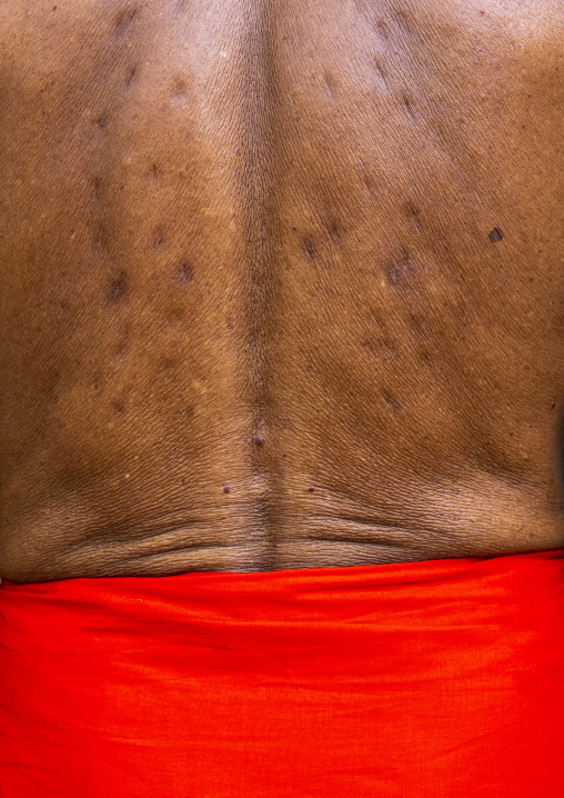 Scars in the back of a devotee who use to hang himself with hooks, Dhaka Division, Dhaka, Bangladesh