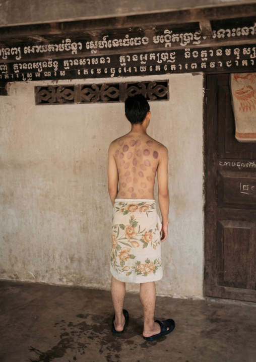 Young man who received vacuum cupping treatment, Battambang province, Battambang, Cambodia