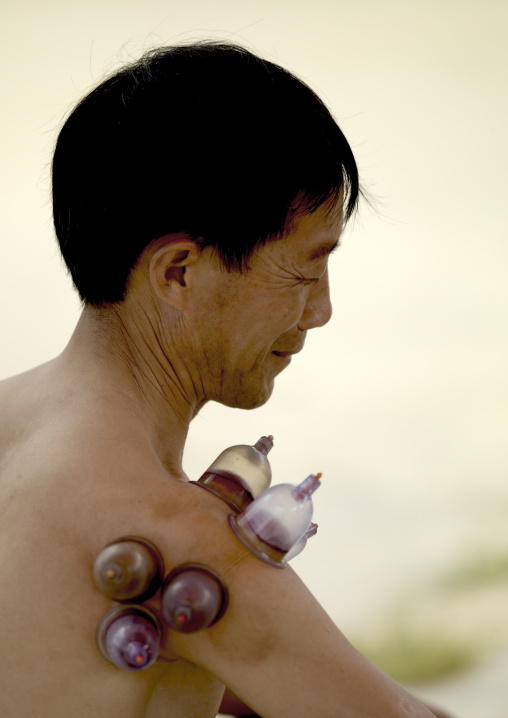 Vacuum Cupping On The Shoulder Of A Man, Menglun, Yunnan Province, China