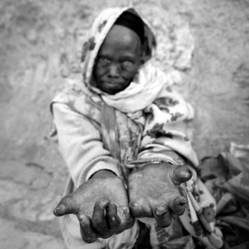 Portrait Of A Leprosis Woman Showing Her Mutilated Hands In Harar, Ethiopia