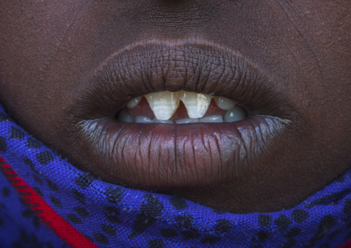 Afar Tribe Woman With Sharpened Teeth, Assaita, Afar Regional State, Ethiopia