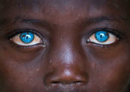 Ethiopian boy called abushe with blue eyes suffering from waardenburg syndrome, Omo valley, Jinka, Ethiopia