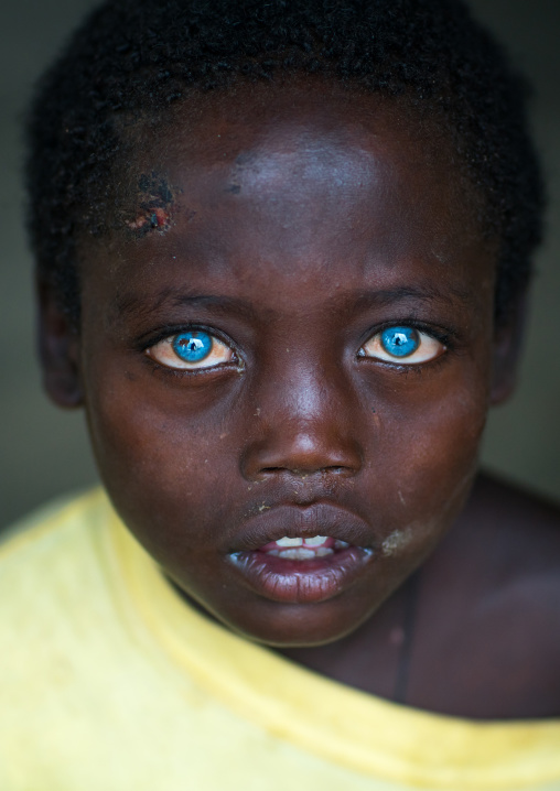 Ethiopian boy called abushe with blue eyes suffering from waardenburg syndrome, Omo valley, Jinka, Ethiopia