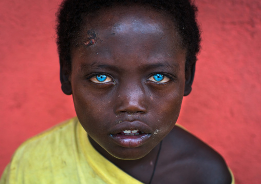 Ethiopian boy called abushe with blue eyes suffering from waardenburg syndrome, Omo valley, Jinka, Ethiopia