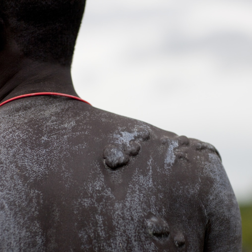 Scars Caused By Stick Fights Wounds, Surma Tribe, Omo Valley, Ethiopia