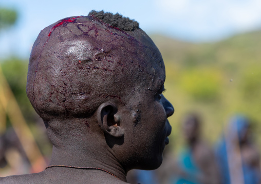 Suri tribe warrior wounded during a donga stick fighting ritual, Omo valley, Kibish, Ethiopia