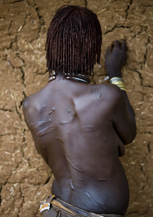 Rear View Of The Scars On The Back Of A Hamar Tribe Woman After Whipping Ceremony, Turmi, Omo Valley, Ethiopia
