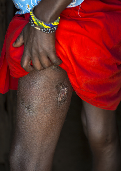 Maasai warrior showing wounds made by a lion on his leg, Nakuru county, Nakuru, Kenya