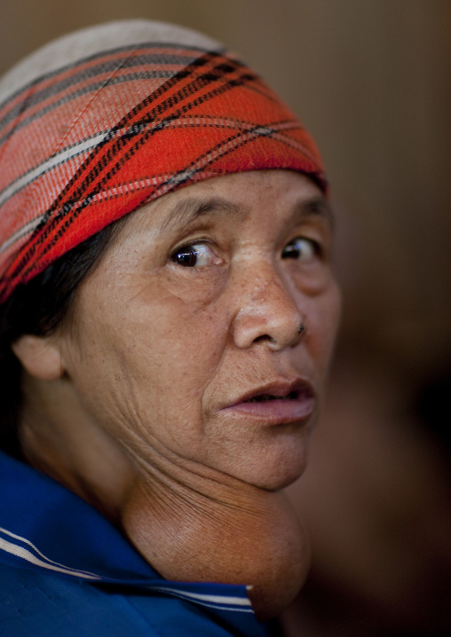 Akha minority woman with a big tumor, Ban ta mi, Laos