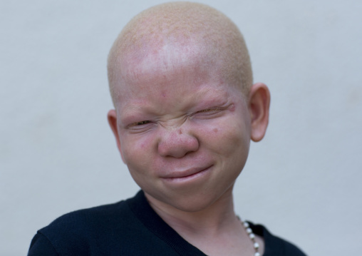 Tanzania, East Africa, Dar es Salaam, mwigulu matonange a boy with albinism at under the same sun house, some men hacked off his left arm with a machete