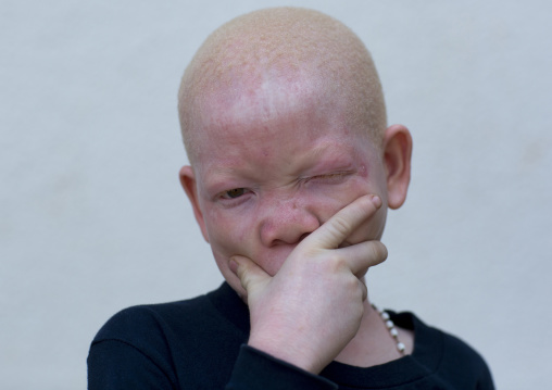 Tanzania, East Africa, Dar es Salaam, mwigulu matonange a boy with albinism at under the same sun house, some men hacked off his left arm with a machete