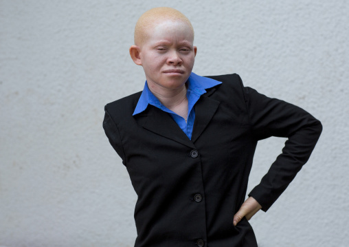 Tanzania, East Africa, Dar es Salaam, miss kabula ngarango a girl with albinism at under the same sun house, her rightarm was  hacked off by men