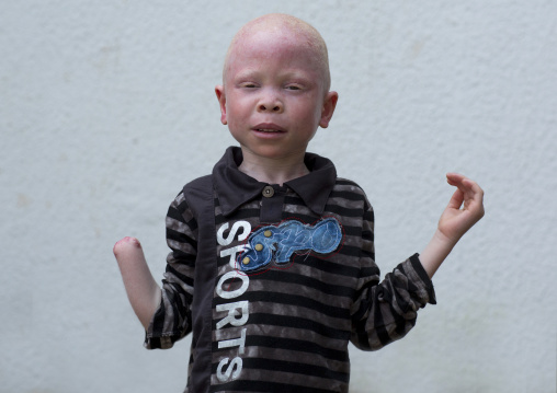 Tanzania, East Africa, Dar es Salaam, baraka cosmas a boy with albinism at under the same sun house, he lost his right hand in a witchcraft attack