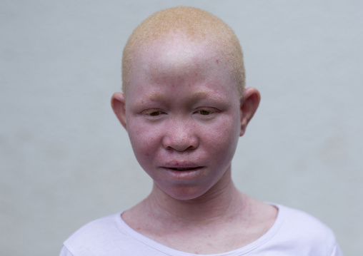 Tanzania, East Africa, Dar es Salaam, pendo serengema a girl with albinism at under the same sun house