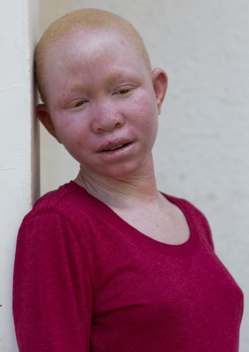 Tanzania, East Africa, Dar es Salaam, pendo serengema a girl with albinism at under the same sun house, she lost her right arm