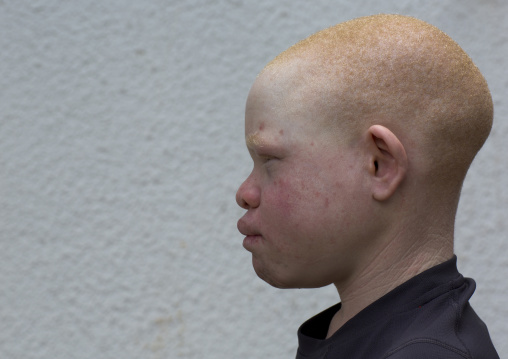 Tanzania, East Africa, Dar es Salaam, emmanuel festo a boy with albinism at under the same sun house, his left armwas hacked off above the elbow, he lost fingers on the right hand and his to